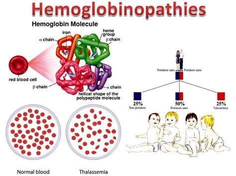 hemoglobin s beta thalassemia|Difficulties in the diagnosis of HbS/beta thalassemia: Really a mild .